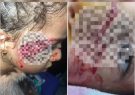 حمله سگ‌های ولگرد در تبریز به دختر ۵ ساله